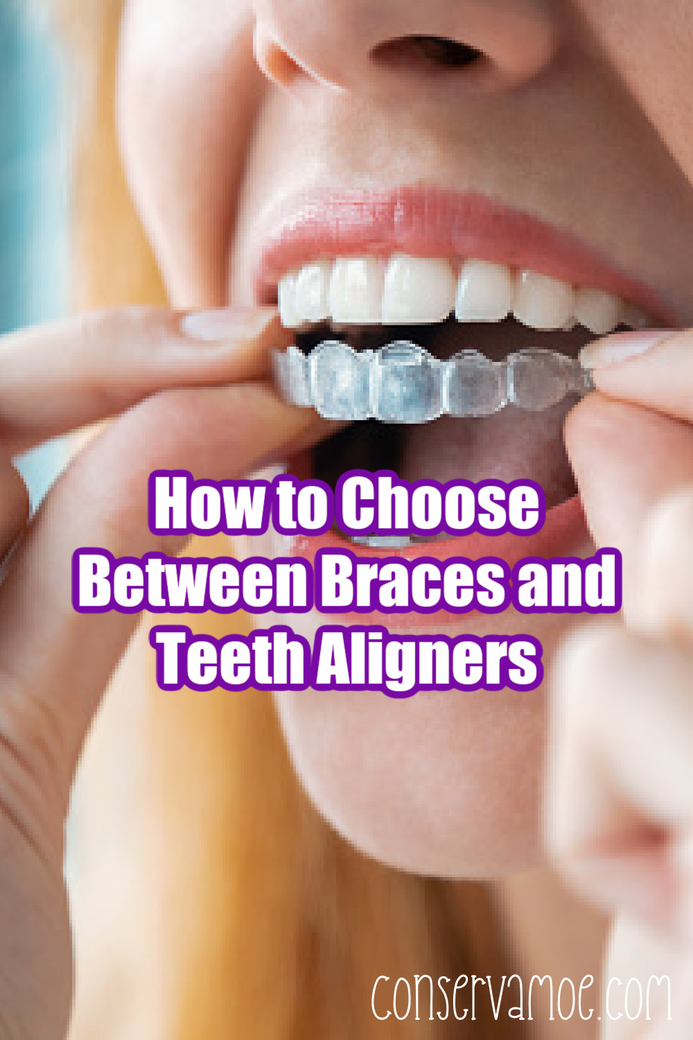How to Choose Between Braces and Teeth Aligners - ConservaMom