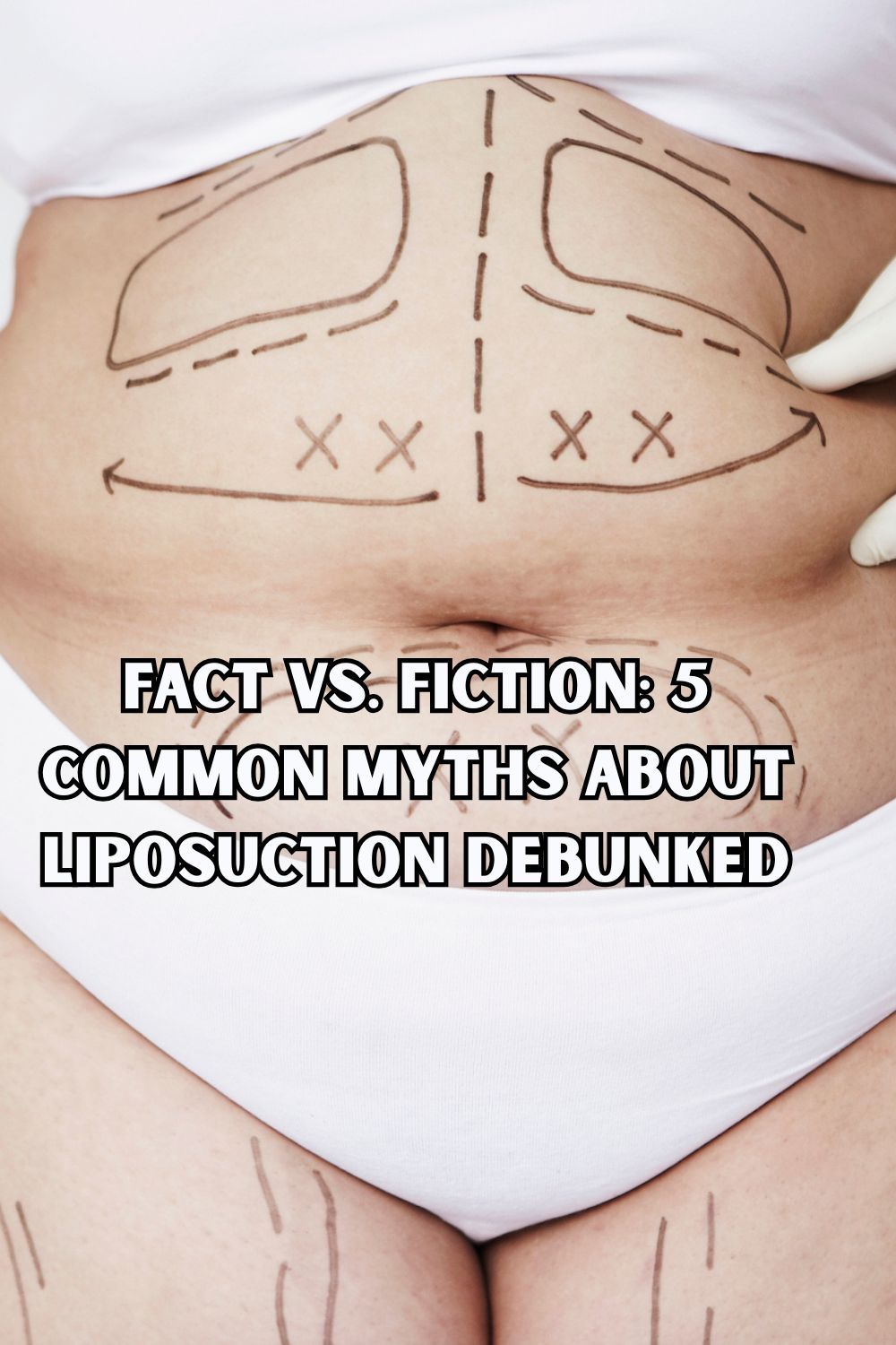 Fact vs. Fiction 5 Common Myths About Liposuction Debunked