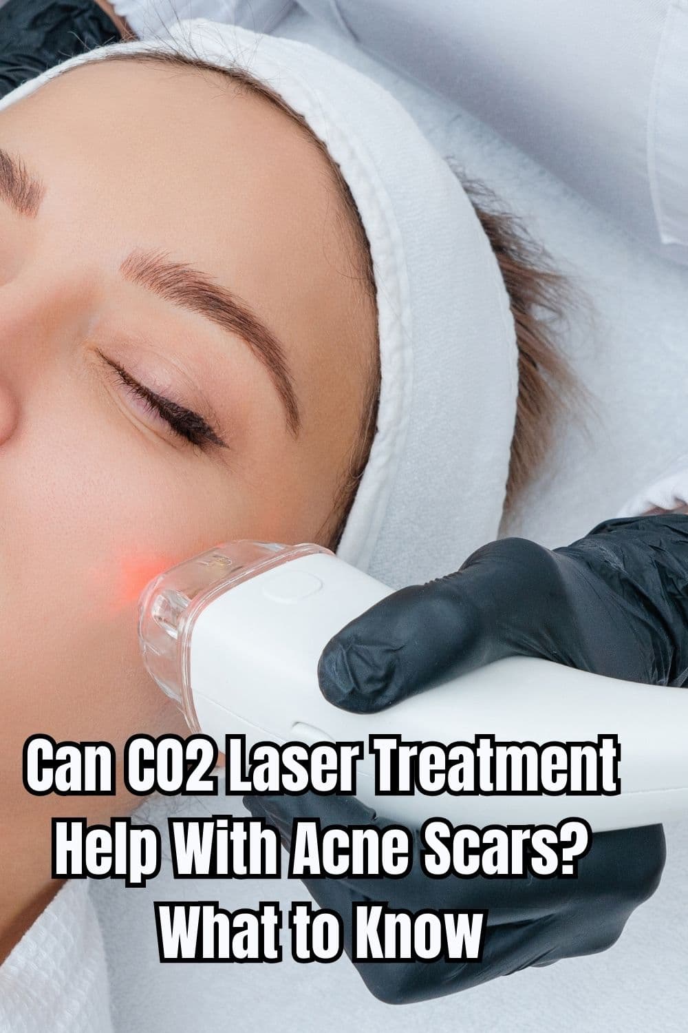 Can CO2 Laser Treatment Help With Acne Scars What to Know