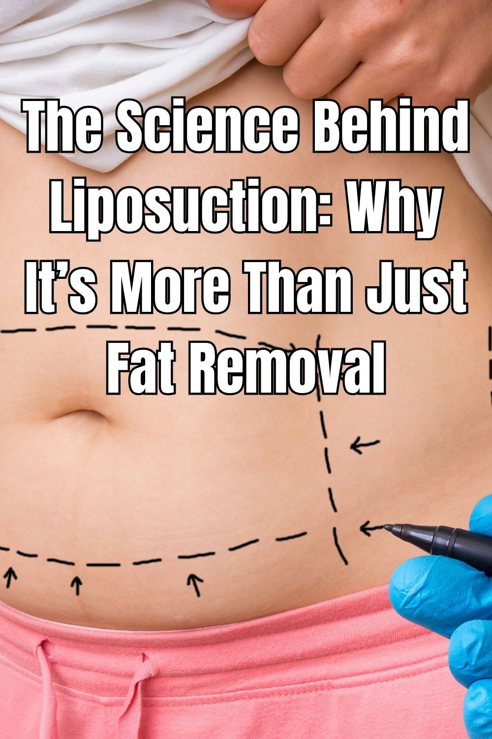 The Science Behind Liposuction: Why It’s More Than Just Fat Removal