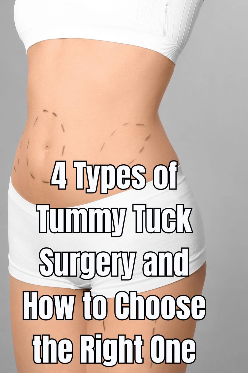 4 Types of Tummy Tuck Surgery and How to Choose the Right One