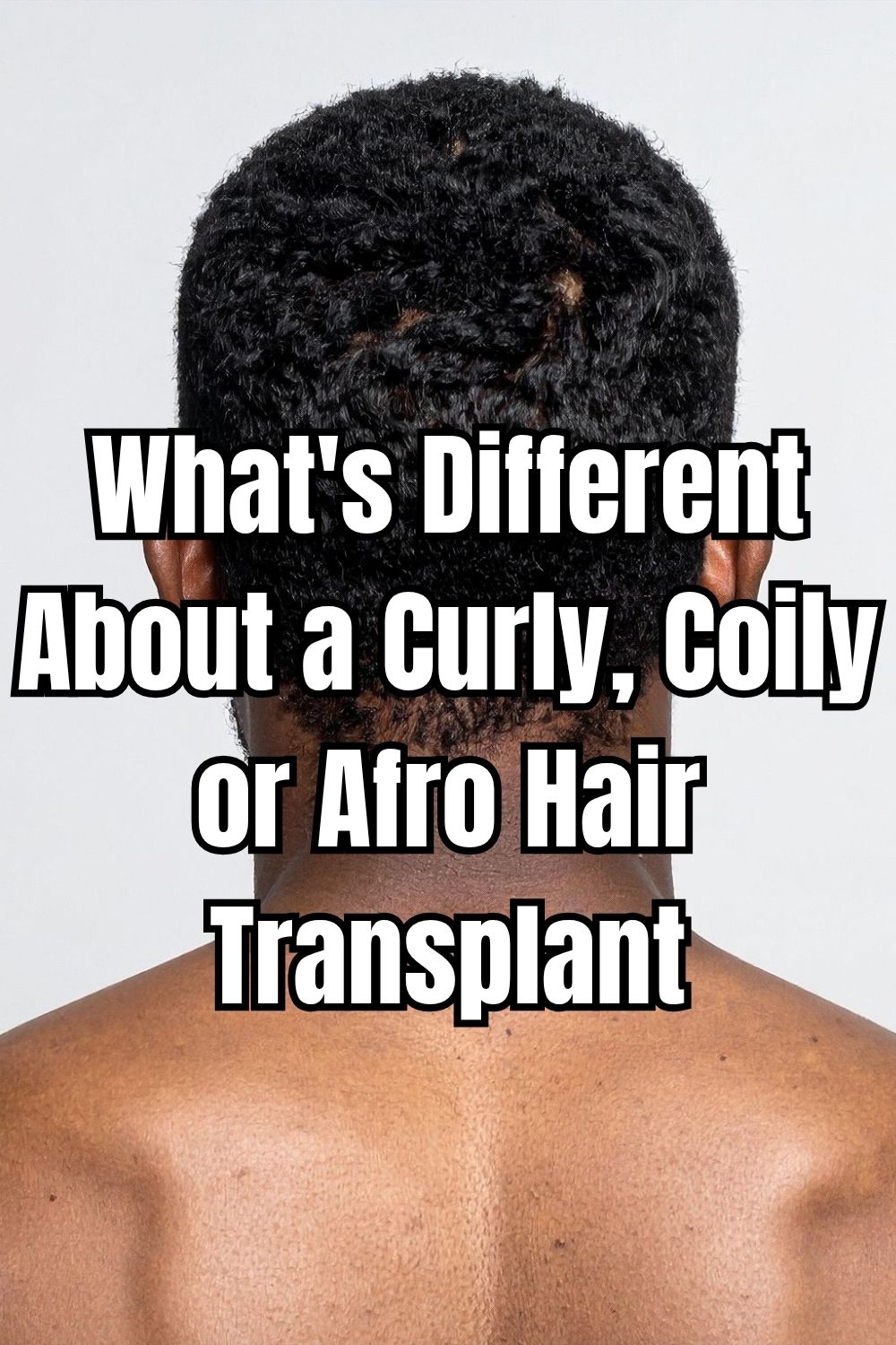 What's Different About a Curly, Coily or Afro Hair Transplant