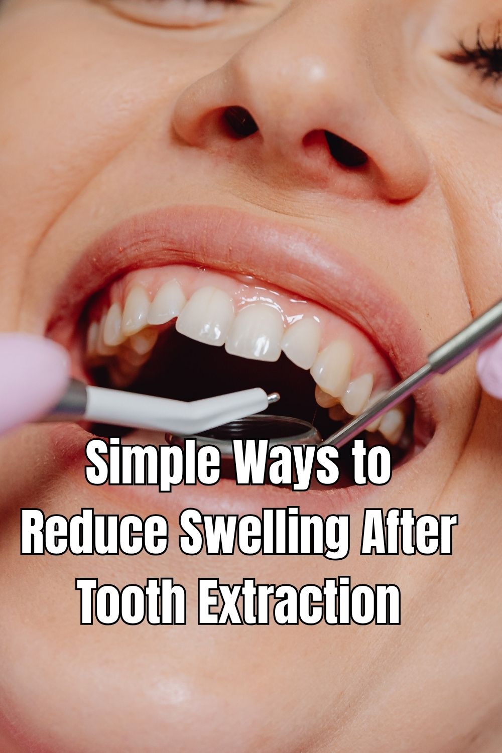 Simple Ways to Reduce Swelling After Tooth Extraction (1)