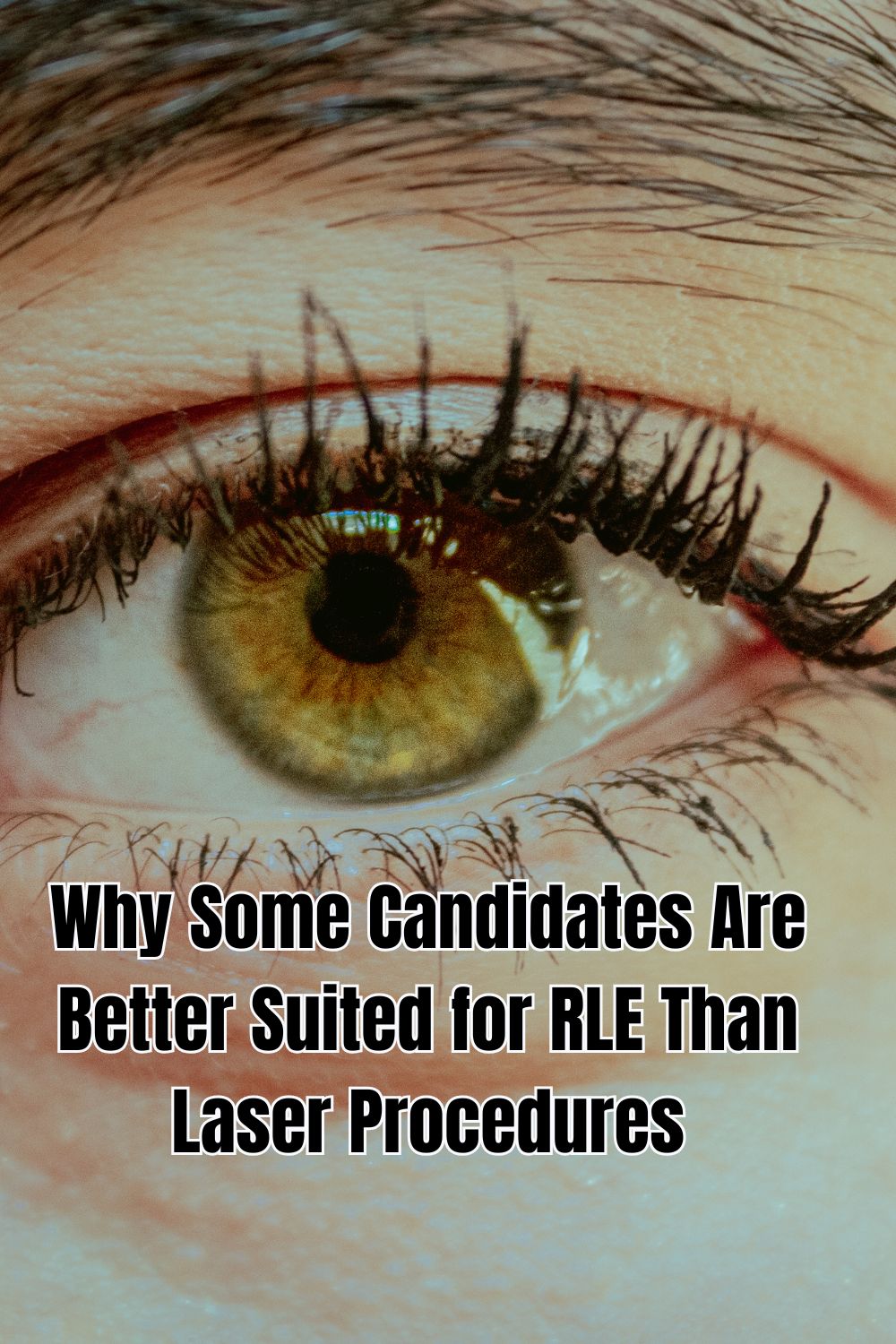 Why Some Candidates Are Better Suited for RLE Than Laser Procedures