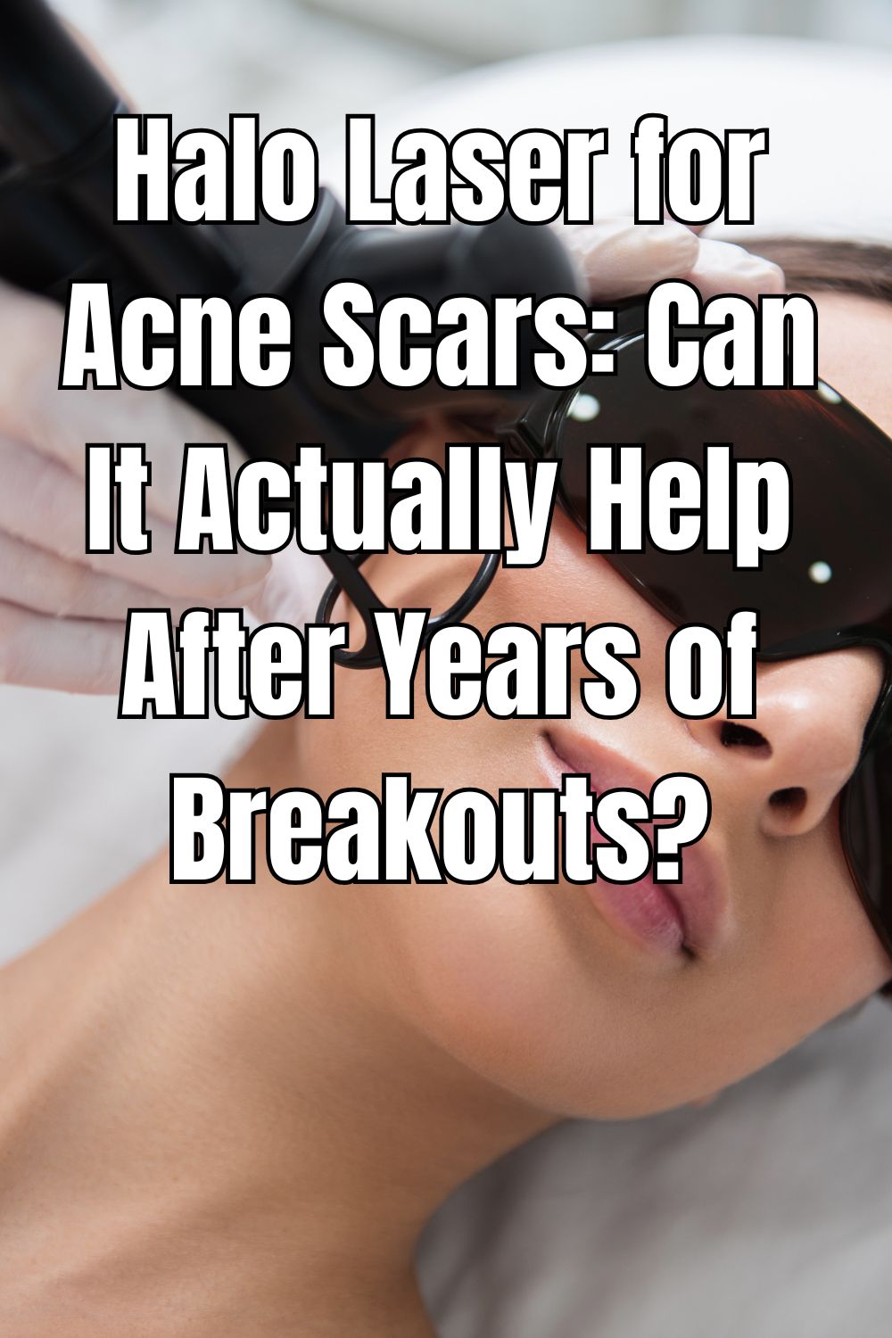 Halo Laser for Acne Scars Can It Actually Help After Years of Breakouts