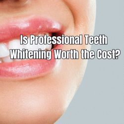 Is Professional Teeth Whitening Worth the Cost