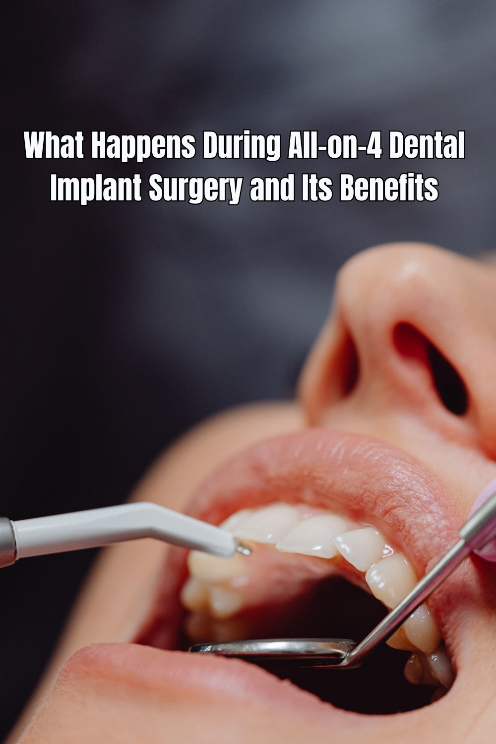 What Happens During All-on-4 Dental Implant Surgery and Its Benefits