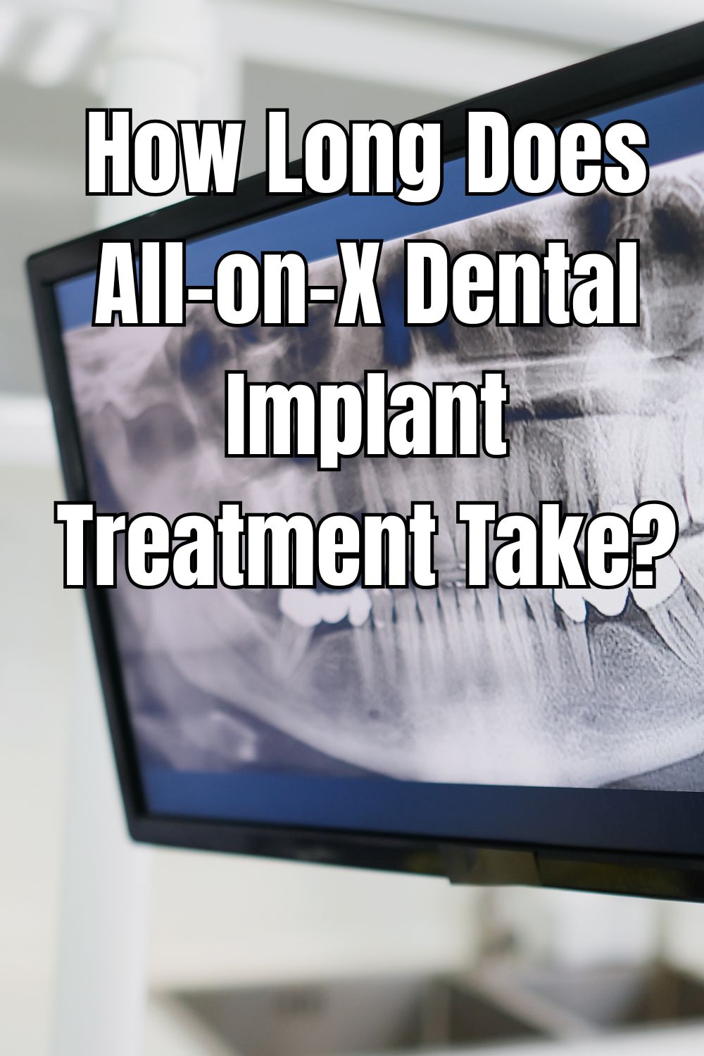 How Long Does All-on-X Dental Implant Treatment Take