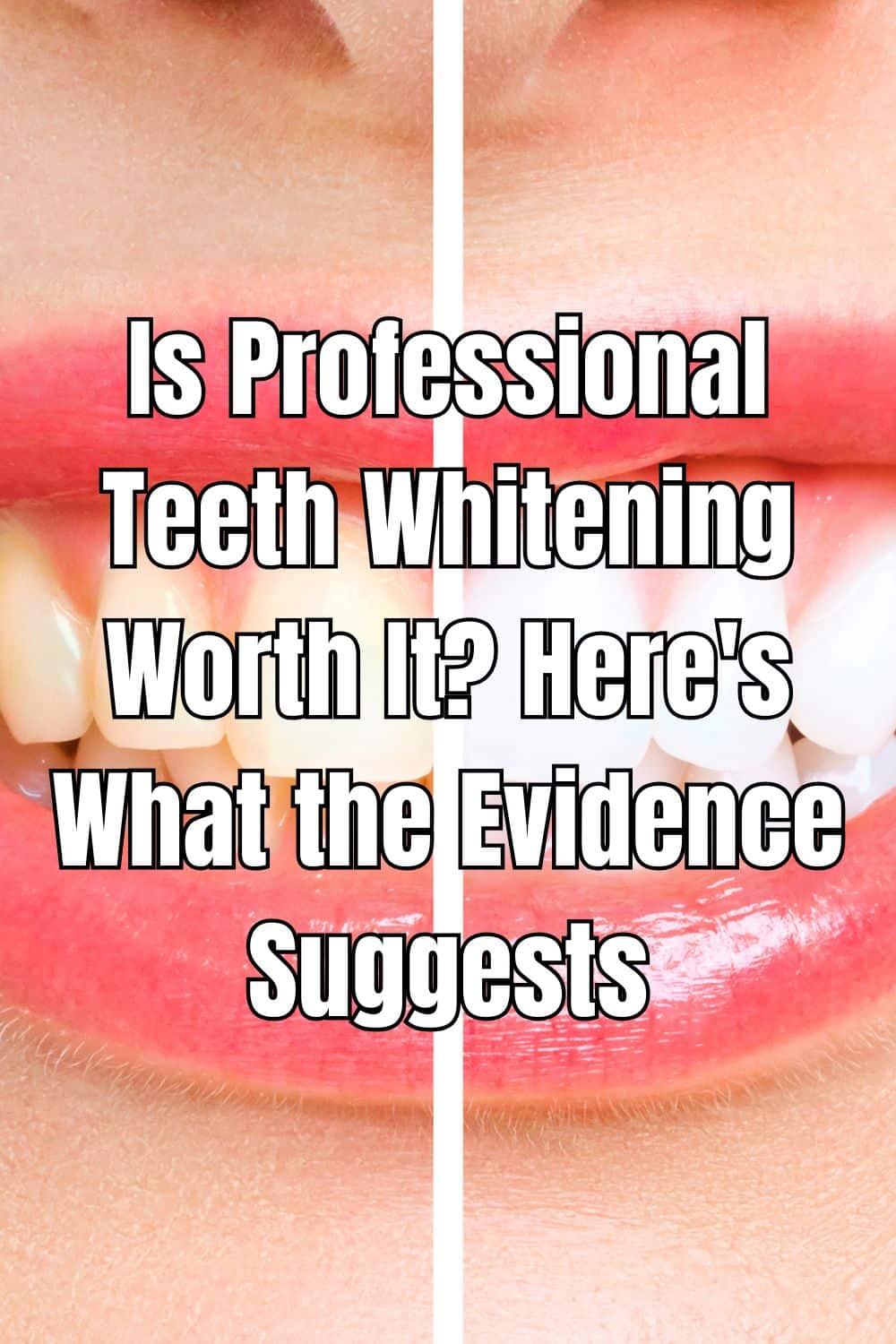 Is Professional Teeth Whitening Worth It Here's What the Evidence Suggests